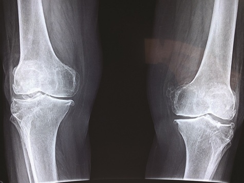 zdjęcie rentgenowskie kolan