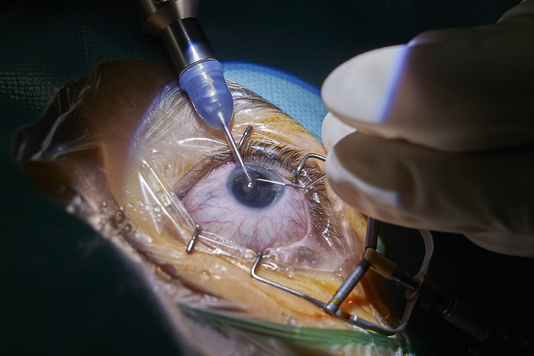 Bliski kadr oka pacjentki podczas zabiegu.