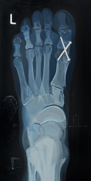 Obraz rentgenu stopy